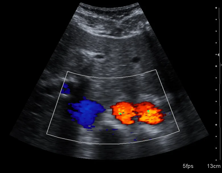 Real ultrasound image showing refraction-induced aorta duplication