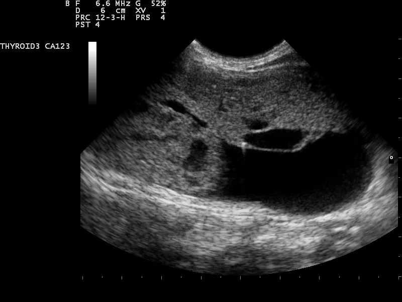 Real ultrasound image showing comet tail artifacts arising from thyroid colloid