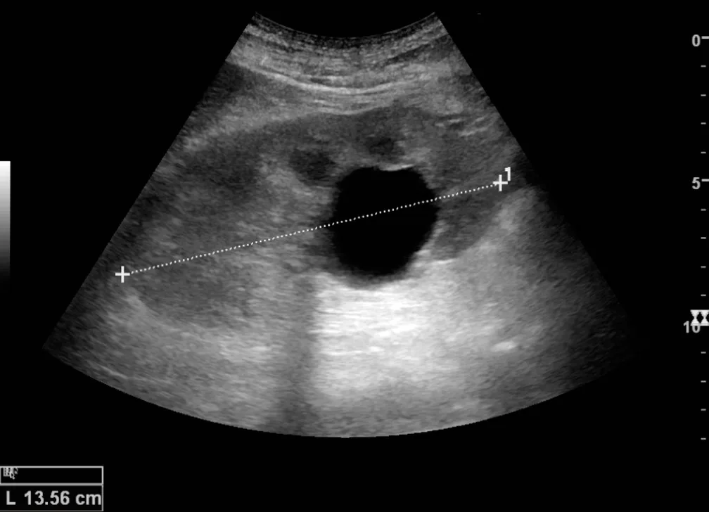 Real ultrasound image showing posterior acoustic enhancement deep to a simple renal cyst