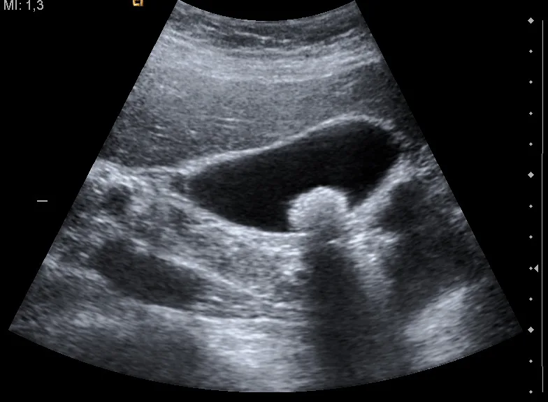 Real ultrasound image showing acoustic shadowing beneath a gallstone