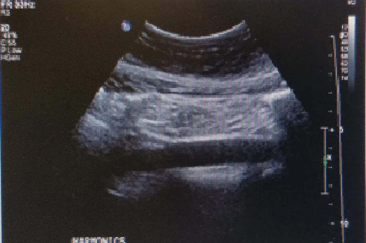 Real ultrasound image showing reverberation artifact